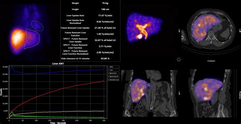 4d liver function hermes|Future Remnant Liver Function .